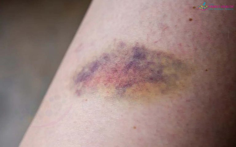 Close-up image of a bruise visibly fading after PEMF therapy treatment, showcasing its effectiveness in accelerating healing.